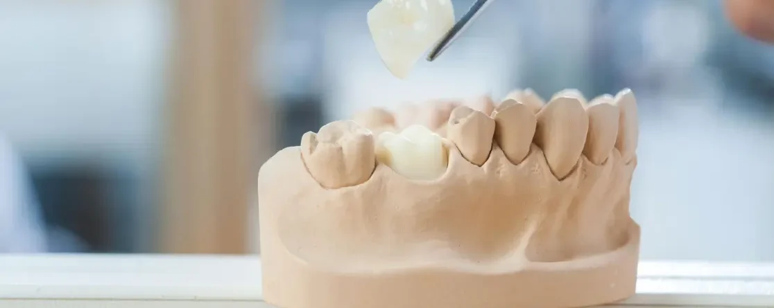 Dental professional positioning a ceramic crown on a dental model