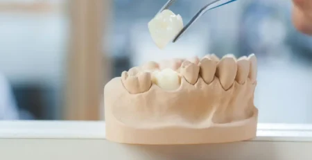 Dental professional positioning a ceramic crown on a dental model